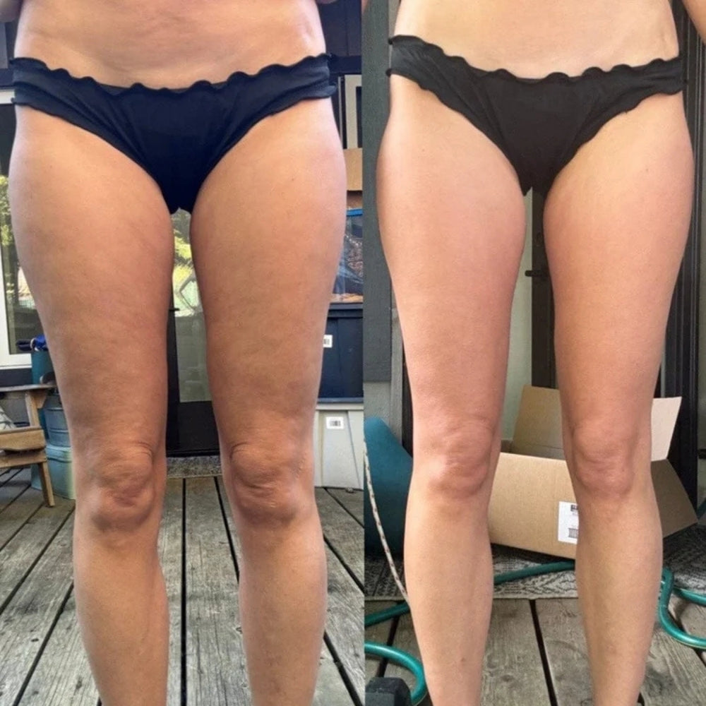 Epcoria™ - Anti-Cellulite Massager